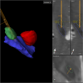 Image of guided DBS: evaluation of lead locations