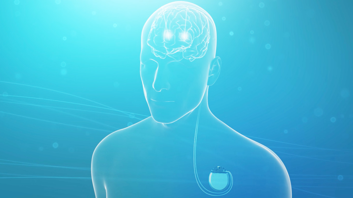 How to diagnose Essential Tremor | Candidates for Deep Brain ...